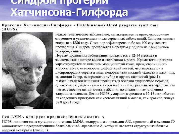 Сэмпсон Гордон Бернс 1996-2014 – американский подросток, страдавший редчайшим генетическим заболеванием – прогерией Являлся мотивационным спикером и